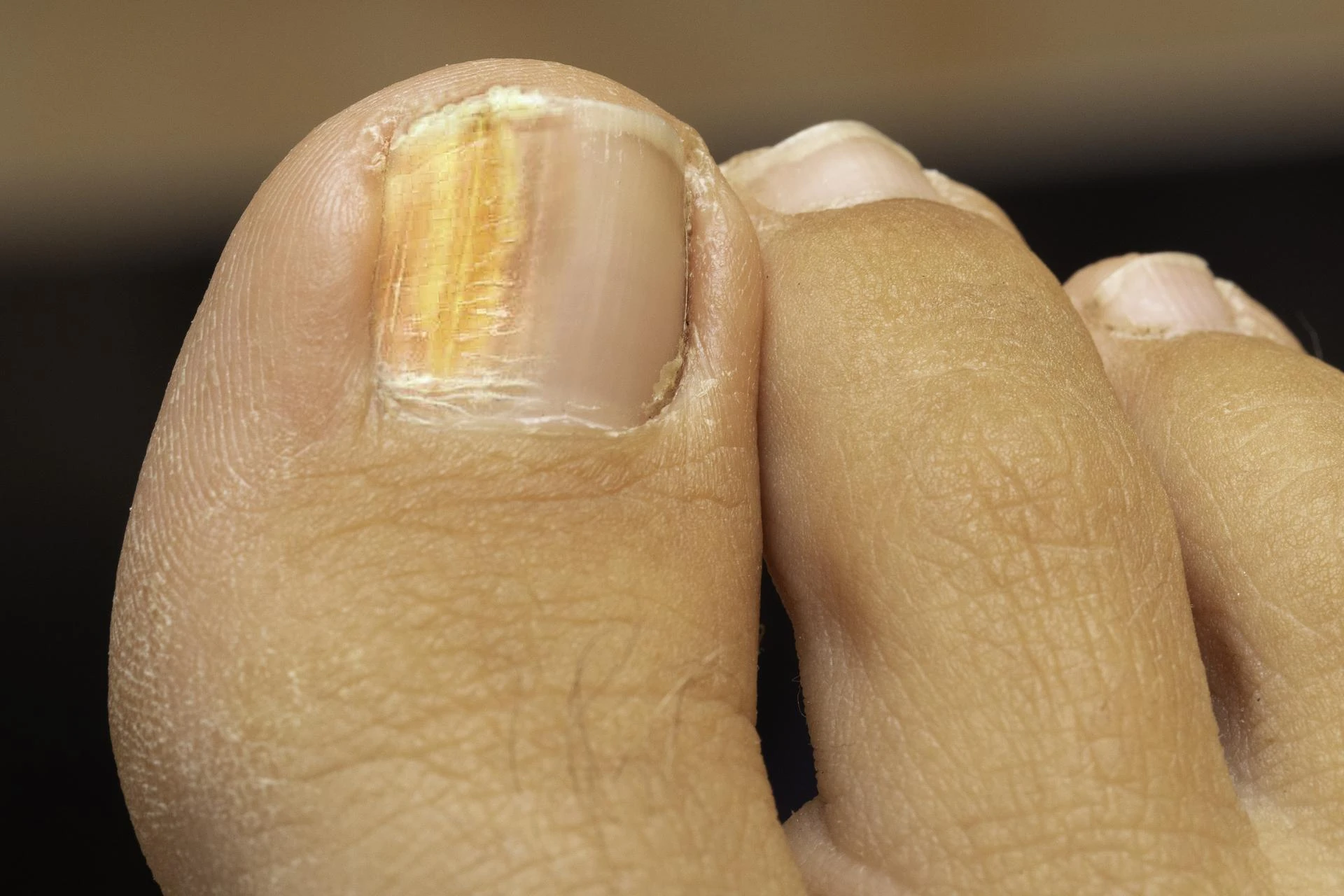 Fungal Nail Infections